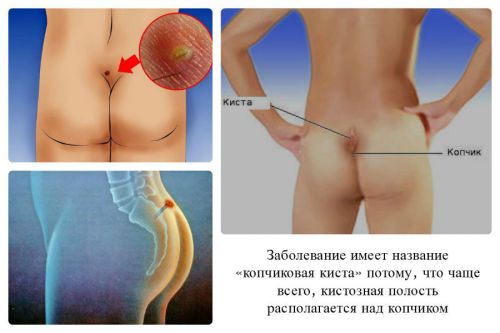 Киста копчика