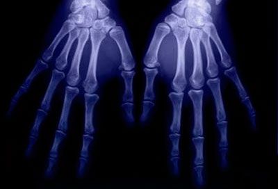 врачи смотрят рентгеновский снимок рук