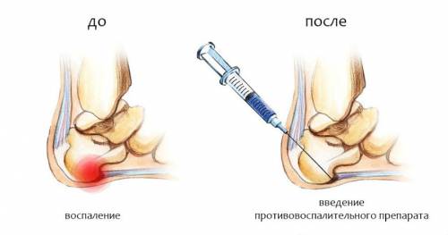 Пяточная блокада