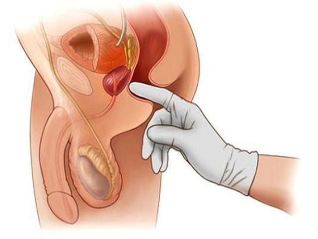 Предстательная железа (простата). Как сохранить здоровой простату