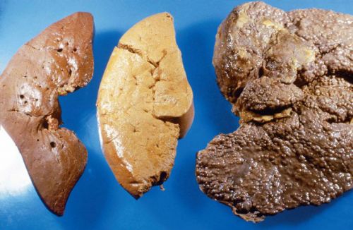 Цирроз печени