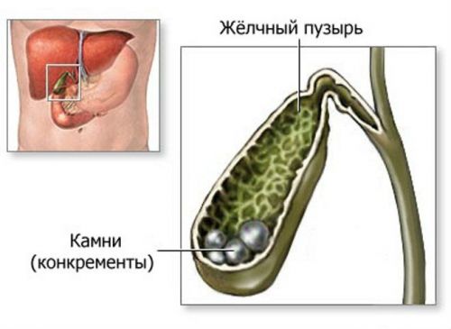 Камни в желчном пузыре