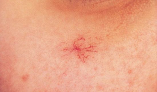 Сосудистая звездочка