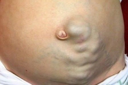 Расширение вен передней брюшной стенки