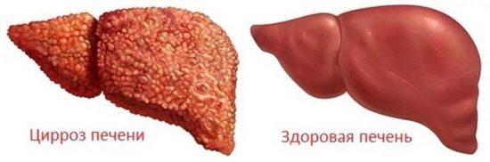 Цирроз печени